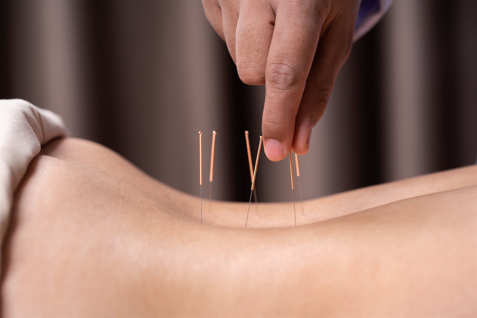 Acupuntura